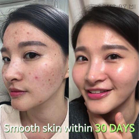 SOMEBYMI AHA BHA PHA 30 Days Miracle Serum Review Result Best Korean Beauty Skincare at Nudie Glow in Australia