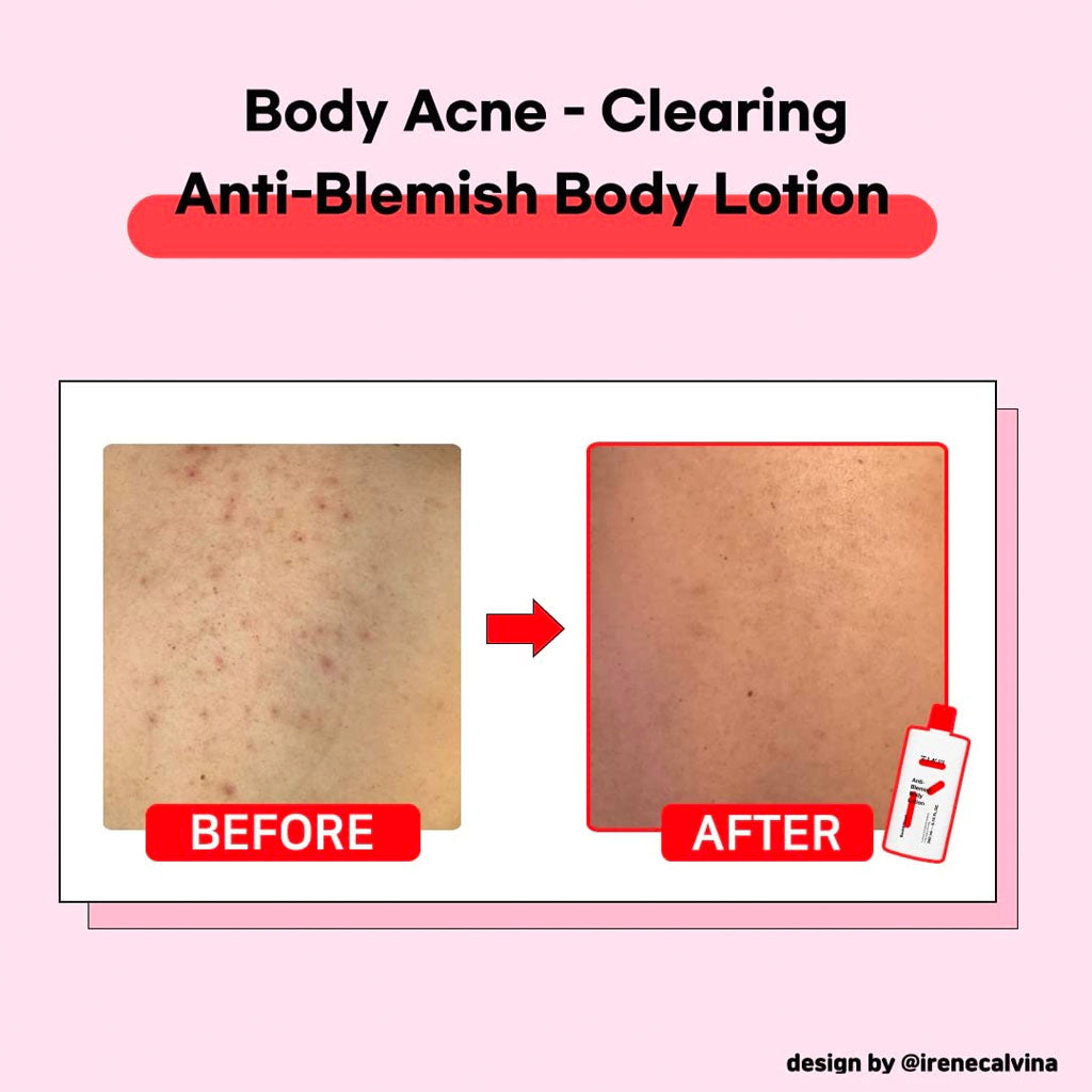 Tiam Anti-Blemish Body Lotion (Back & Chest) - Nudie Glow Australia