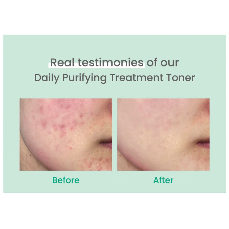 AXIS-Y Daily Purifying Treatment Toner Before After